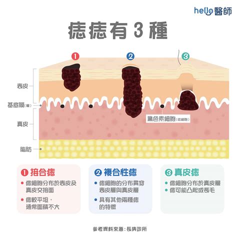 紅色痣代表什麼|為什麼臉上的痣越來越多？皮膚科醫師解析長痣原因、。